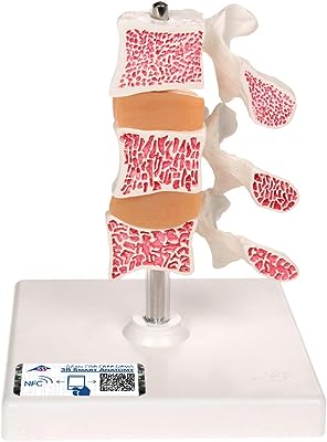 骨粗しょう症を3段階（健康・骨密度の減少・圧迫変形）で示した模型 - 骨粗鬆症モデル，3段型 - 3B Scientific